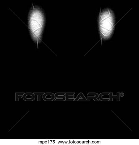 Knee - Coronal View Large Illustration Stock Illustration - Knee - Coronal. Fotosearch