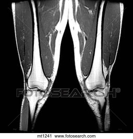 Clip Art - Legs - Coronal. Fotosearch