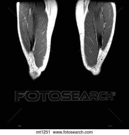 Legs - Coronal View Large Illustration Clip Art - Legs - Coronal. Fotosearch