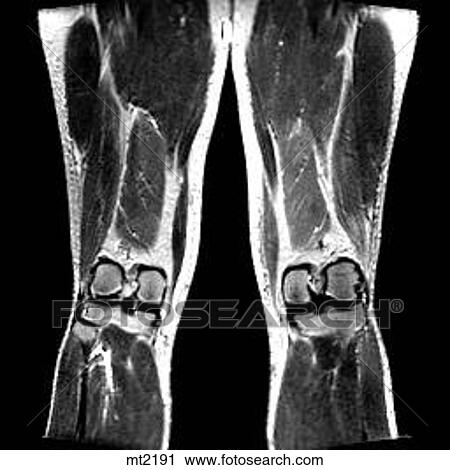 Clip Art - Legs - Coronal. Fotosearch