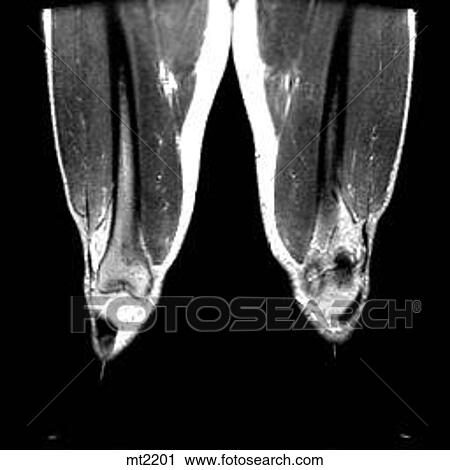 Clip Art - Legs - Coronal. Fotosearch