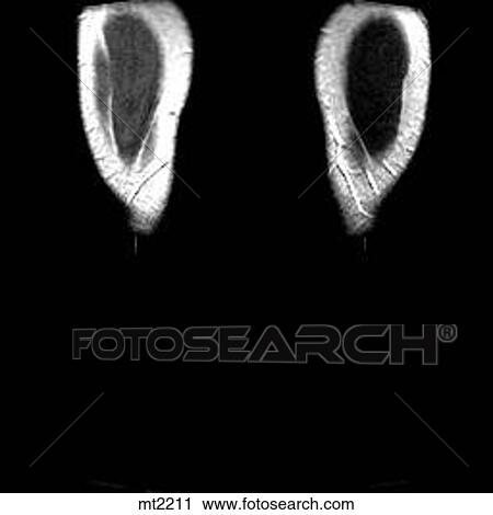 Clip Art - Legs - Coronal. Fotosearch