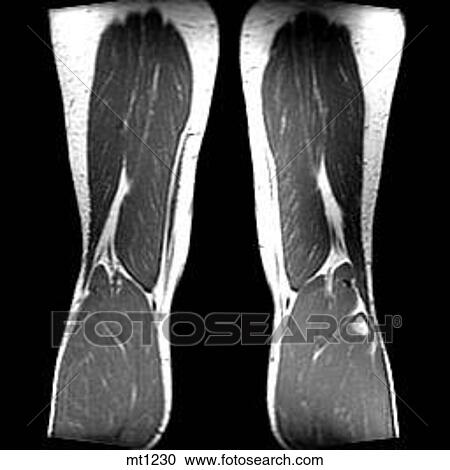 Legs - Coronal View Large Illustration Clipart - Legs - Coronal. Fotosearch