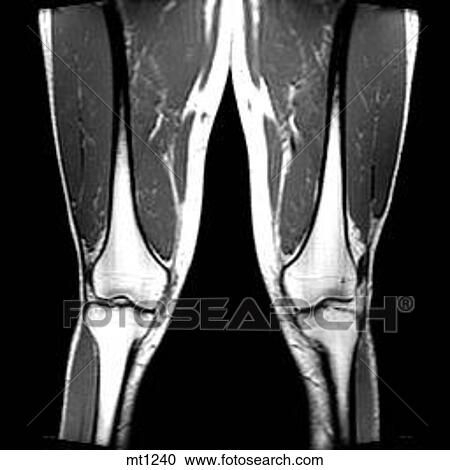 Legs - Coronal View Large Illustration Clipart - Legs - Coronal. Fotosearch