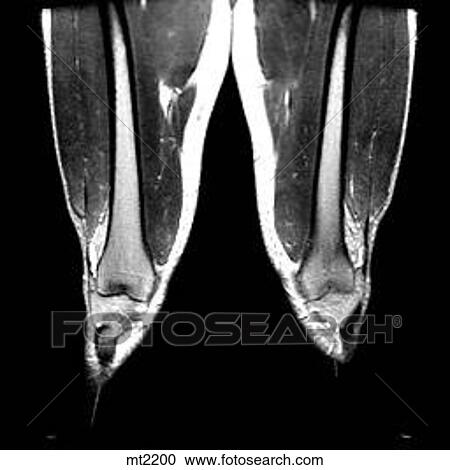 Clipart - Legs - Coronal. Fotosearch