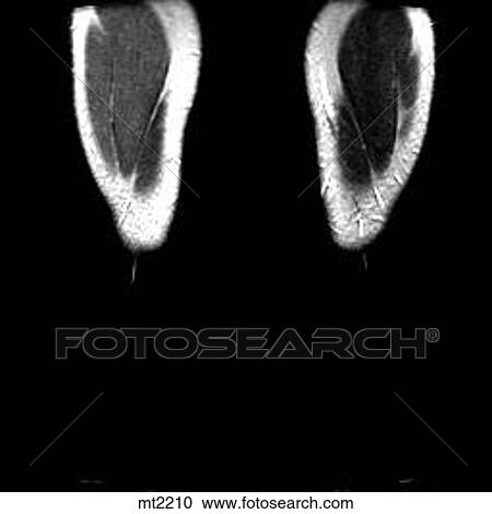 Clipart - Legs - Coronal. Fotosearch