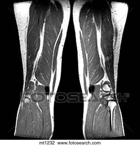 Drawing - Legs - Coronal. Fotosearch
