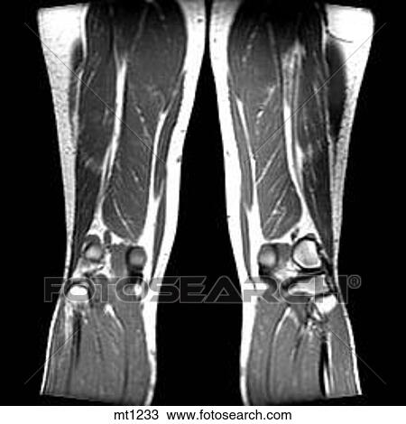 Drawing - Legs - Coronal. Fotosearch