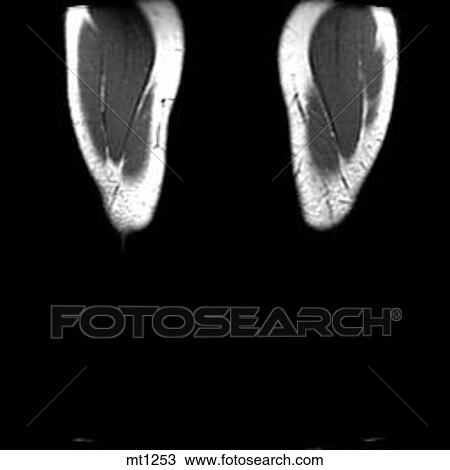 Legs - Coronal View Large Illustration Drawing - Legs - Coronal. Fotosearch