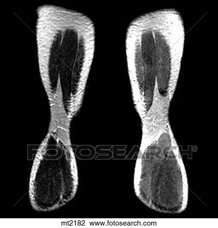 Legs - Coronal View Large Illustration Drawing - Legs - Coronal. Fotosearch