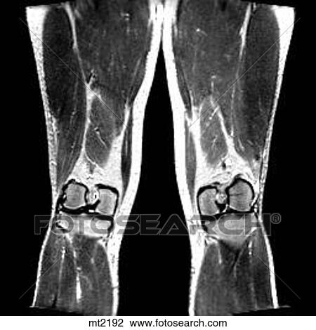 Legs - Coronal View Large Illustration Drawing - Legs - Coronal. Fotosearch