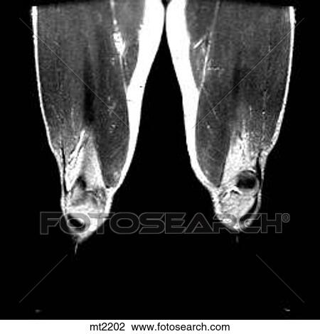 Drawing - Legs - Coronal. Fotosearch