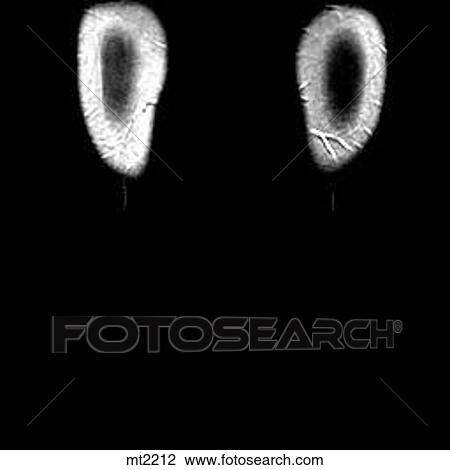Legs - Coronal View Large Illustration Drawing - Legs - Coronal. Fotosearch