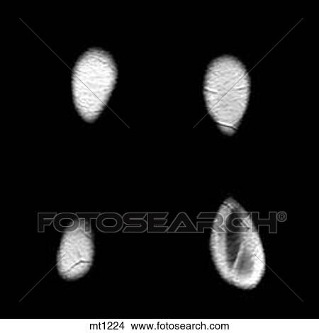Legs - Coronal View Large Illustration Stock Illustration - Legs - Coronal. Fotosearch