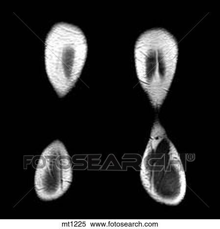 Legs - Coronal View Large Illustration Stock Illustration - Legs - Coronal. Fotosearch