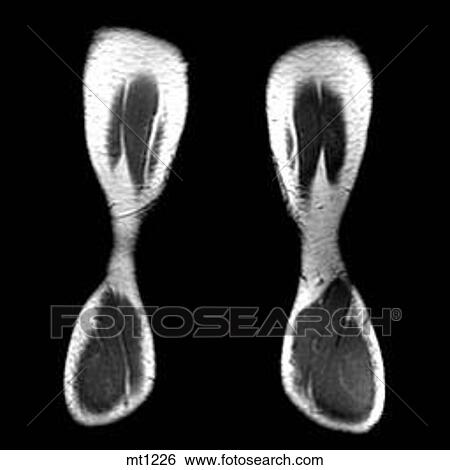 Legs - Coronal View Large Illustration Stock Illustration - Legs - Coronal. Fotosearch