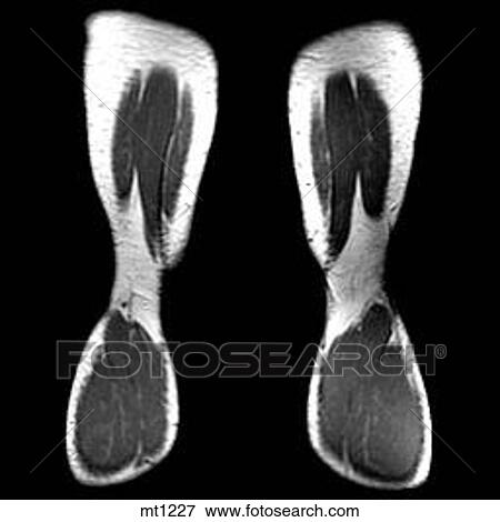 Stock Illustration - Legs - Coronal. Fotosearch
