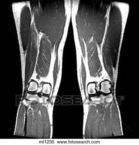Stock Illustration - Legs - Coronal. Fotosearch