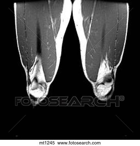 Legs - Coronal View Large Illustration Stock Illustration - Legs - Coronal. Fotosearch