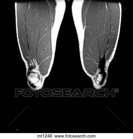 Stock Illustration - Legs - Coronal. Fotosearch