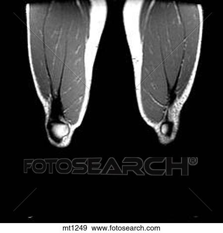 Stock Illustration - Legs - Coronal. Fotosearch