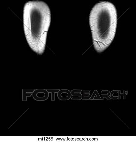 Legs - Coronal View Large Illustration Stock Illustration - Legs - Coronal. Fotosearch