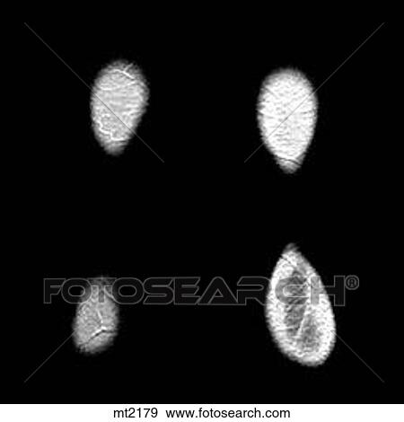 Legs - Coronal View Large Illustration Stock Illustration - Legs - Coronal. Fotosearch