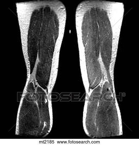 Legs - Coronal View Large Illustration Stock Illustration - Legs - Coronal. Fotosearch