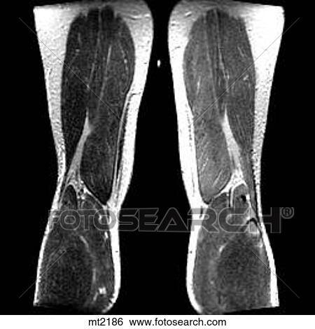 Legs - Coronal View Large Illustration Stock Illustration - Legs - Coronal. Fotosearch