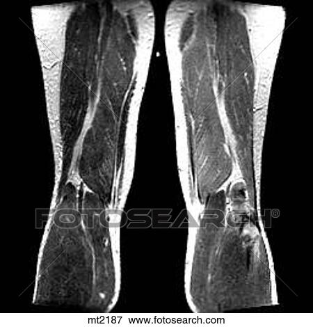 Stock Illustration - Legs - Coronal. Fotosearch