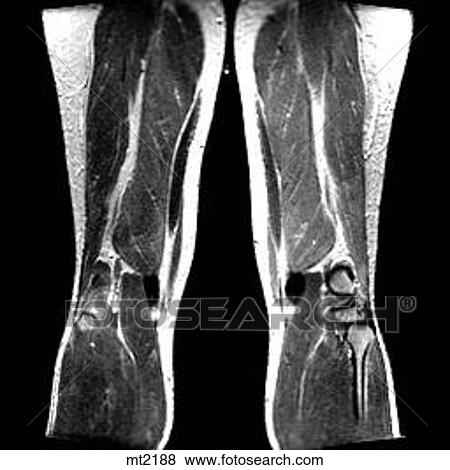 Legs - Coronal View Large Illustration Stock Illustration - Legs - Coronal. Fotosearch