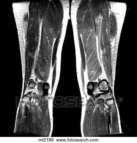 Legs - Coronal View Large Illustration Stock Illustration - Legs - Coronal. Fotosearch