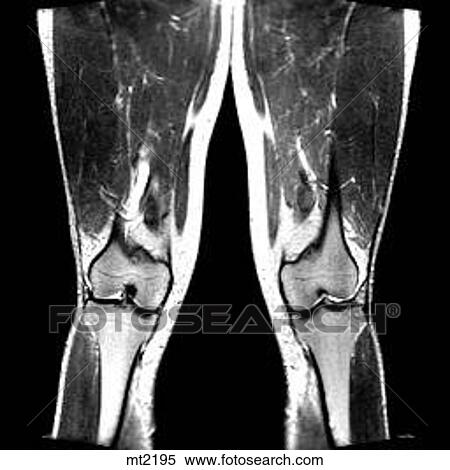 Legs - Coronal View Large Illustration Stock Illustration - Legs - Coronal. Fotosearch