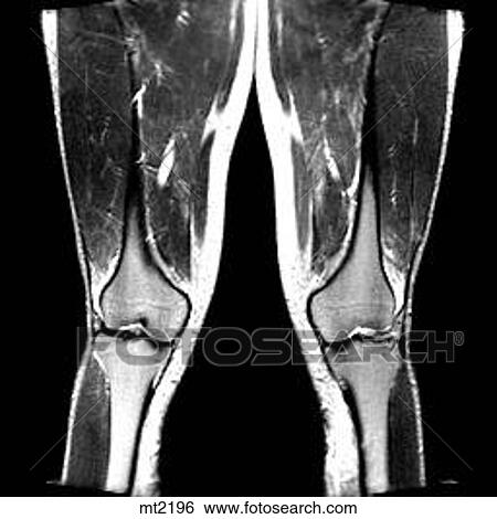 Stock Illustration - Legs - Coronal. Fotosearch