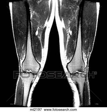 Legs - Coronal View Large Illustration Stock Illustration - Legs - Coronal. Fotosearch