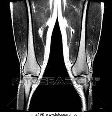 Legs - Coronal View Large Illustration Stock Illustration - Legs - Coronal. Fotosearch