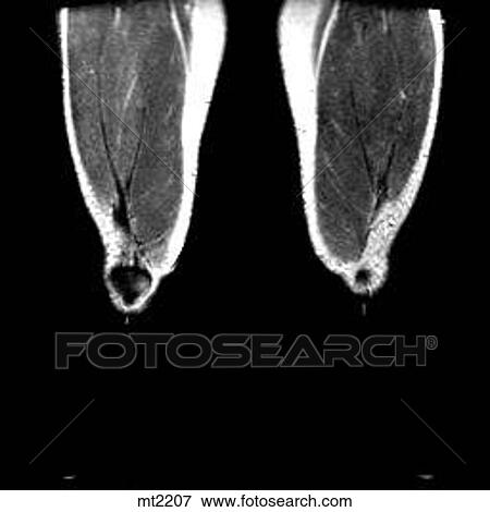 Legs - Coronal View Large Illustration Stock Illustration - Legs - Coronal. Fotosearch