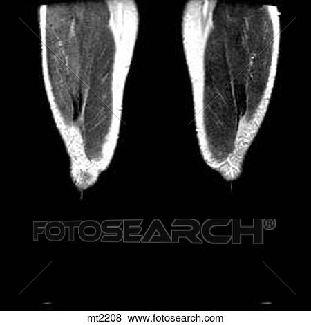 Legs - Coronal View Large Illustration Stock Illustration - Legs - Coronal. Fotosearch