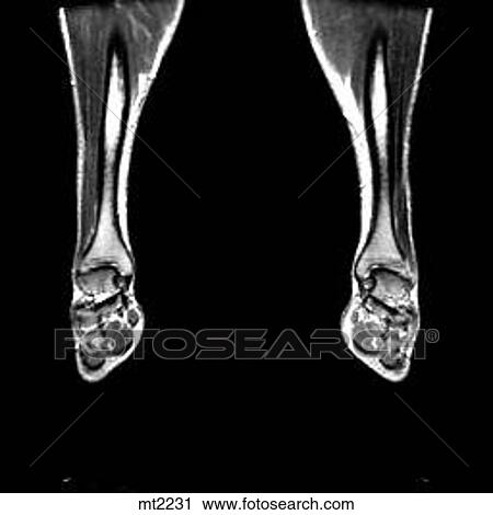 Clip Art - Lower Legs and Feet - Coronal. Fotosearch