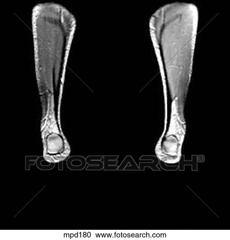 Clipart - Lower Legs and Feet - Coronal. Fotosearch