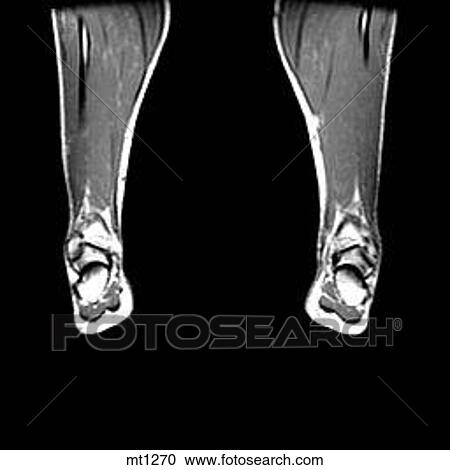 Lower Legs and Feet - Coronal View Large Illustration Clipart - Lower Legs and Feet - Coronal. Fotosearch