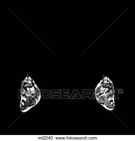 Lower Legs and Feet - Coronal View Large Illustration Clipart - Lower Legs and Feet - Coronal. Fotosearch