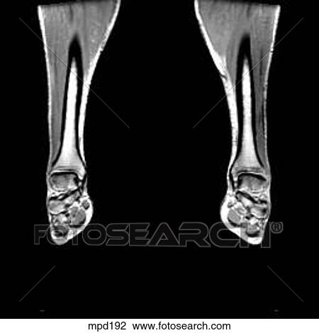 Lower Legs and Feet - Coronal View Large Illustration Drawing - Lower Legs and Feet - Coronal. Fotosearch