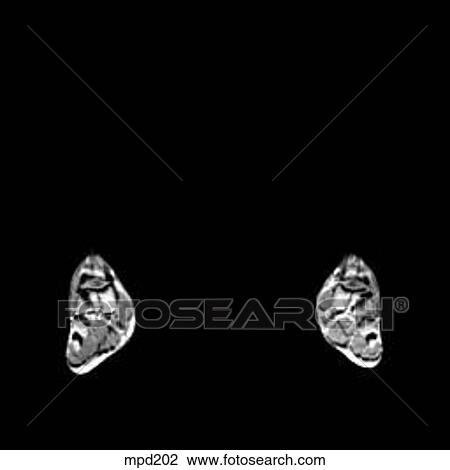Drawing - Lower Legs and Feet - Coronal. Fotosearch