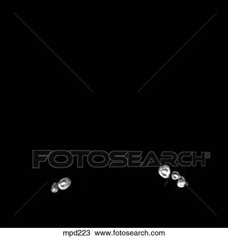 Drawing - Lower Legs and Feet - Coronal. Fotosearch