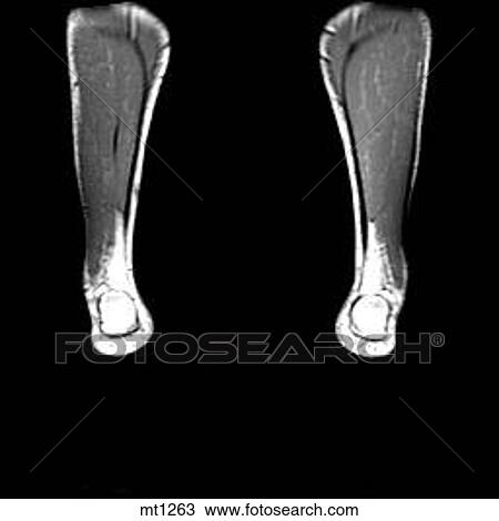 Lower Legs and Feet - Coronal View Large Illustration Drawing - Lower Legs and Feet - Coronal. Fotosearch