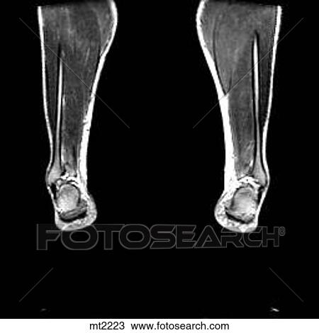 Lower Legs and Feet - Coronal View Large Illustration Drawing - Lower Legs and Feet - Coronal. Fotosearch