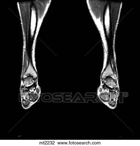 Lower Legs and Feet - Coronal View Large Illustration Drawing - Lower Legs and Feet - Coronal. Fotosearch