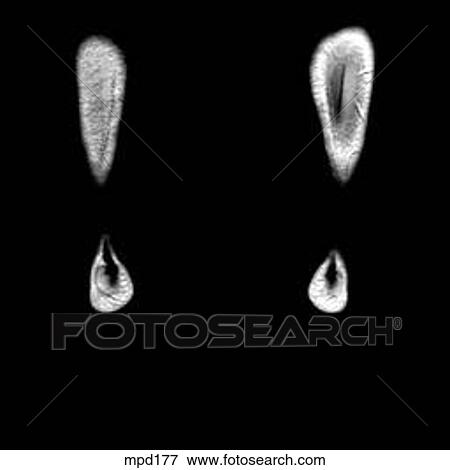 Lower Legs and Feet - Coronal View Large Illustration Stock Illustration - Lower Legs and Feet - Coronal. Fotosearch