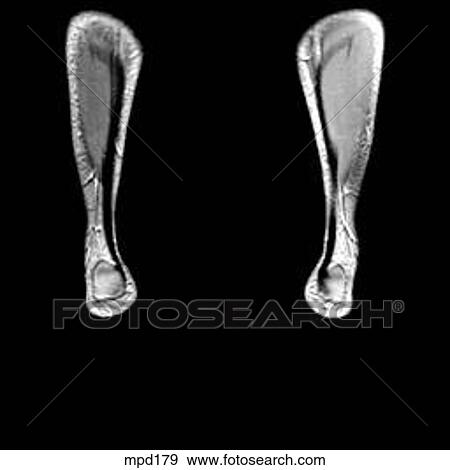 Lower Legs and Feet - Coronal View Large Illustration Stock Illustration - Lower Legs and Feet - Coronal. Fotosearch